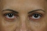 Restylane 