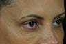 Restylane 