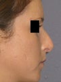 Rhinoplasty