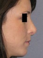 Rhinoplasty