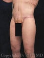 Lower body lift; medial thigh lift