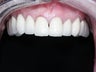 smile makeover