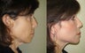 Small Image Lift, Full Face Laser Resurfacing