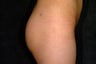 buttock augmentation