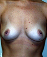Breast Augmentation