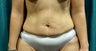 Body Contouring after Massive Weight Loss