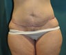 Body Contouring after Massive Weight Loss
