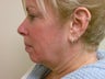 Neck Lift