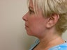 Neck Lift