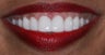 Veneers, gumlift