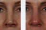 Revision Rhinoplasty