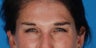 Botox