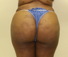 Brazilian butt lift