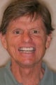 Smile Makeover using all ceramic crowns