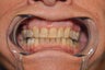 Invisalign to replace a HIDEOUS crown/tooth