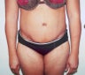 Tummy Tuck