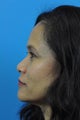 Rhinoplasty