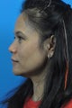 Rhinoplasty