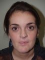 Rhinoplasty