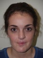Rhinoplasty