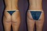 Butt Lift