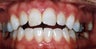 Orthodontic braces with miniscrew support to close openbite