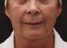 Fat Transfer to Face