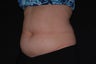 CoolSculpting on belly