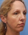 Cheek Dermafillers, Cheek Enhancement, Eye Dermafillers, Facial Dermafillers 