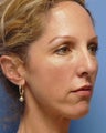 Cheek Dermafillers, Cheek Enhancement, Eye Dermafillers, Facial Dermafillers 