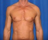 Pec Implants 