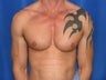 Pec Implants 