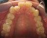 Invisalign