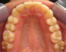 Invisalign