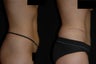 Tummy Tuck