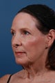 Facelift