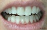 Dental Crown