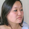 Chin Liposuction 