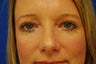 Eyelid Surgery