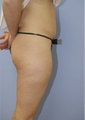 Liposuction