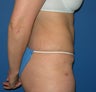 Tummy Tuck
