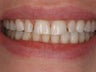 10 Porcelain Veneers