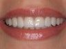 10 Porcelain Veneers