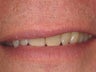 10 Porcelain Veneers