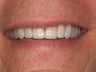 10 Porcelain Veneers
