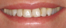 10 Porcelain Veneers