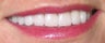 10 Porcelain Veneers