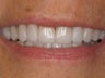 12 Porcelain Veneers
