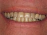 Porcelain Veneers and Crowns