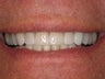Porcelain Veneers and Crowns